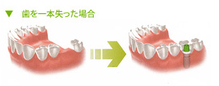 歯を一本失った場合